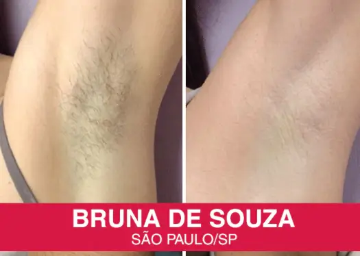 Resultado antes e depois — Bruna