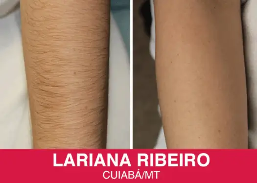 Resultado antes e depois — Lariana